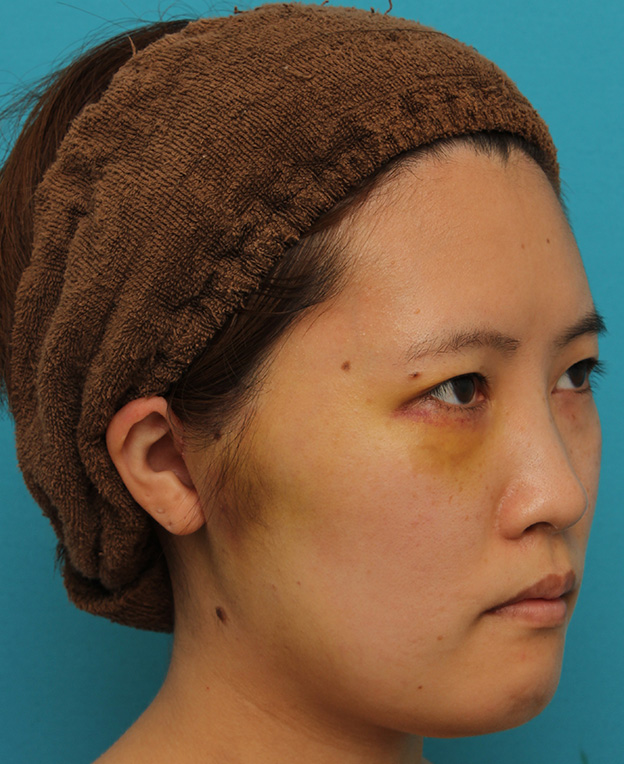 ミニフェイスリフト（頬のたるみ取り）,ミニフェイスリフトの症例 20代女性の頬を中心としたお顔のたるみの改善,1週間後（抜糸時）,mainpic_minilift007h.jpg