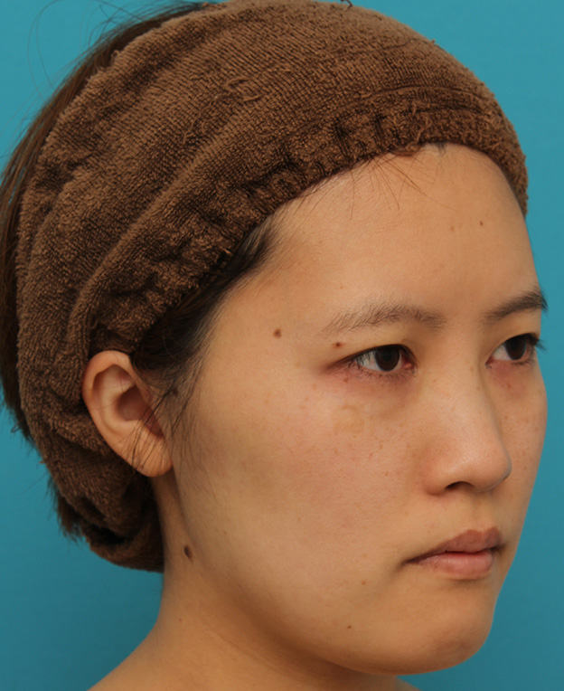 ミニフェイスリフト（頬のたるみ取り）,ミニフェイスリフトの症例 20代女性の頬を中心としたお顔のたるみの改善,1ヶ月後,mainpic_minilift007i.jpg