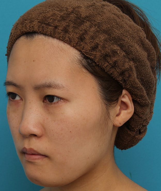 ミニフェイスリフト（頬のたるみ取り）,ミニフェイスリフトの症例 20代女性の頬を中心としたお顔のたるみの改善,手術前,mainpic_minilift007k.jpg
