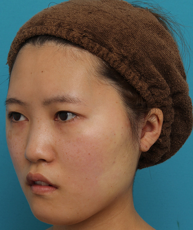 ミニフェイスリフト（頬のたるみ取り）,ミニフェイスリフトの症例 20代女性の頬を中心としたお顔のたるみの改善,手術直後,mainpic_minilift007l.jpg