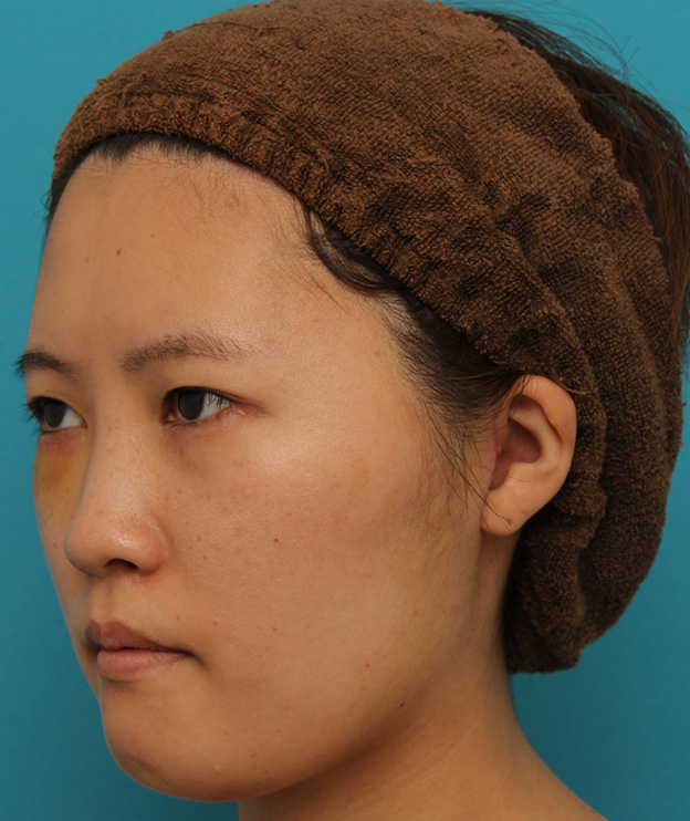 ミニフェイスリフト（頬のたるみ取り）,ミニフェイスリフトの症例 20代女性の頬を中心としたお顔のたるみの改善,1週間後（抜糸時）,mainpic_minilift007m.jpg