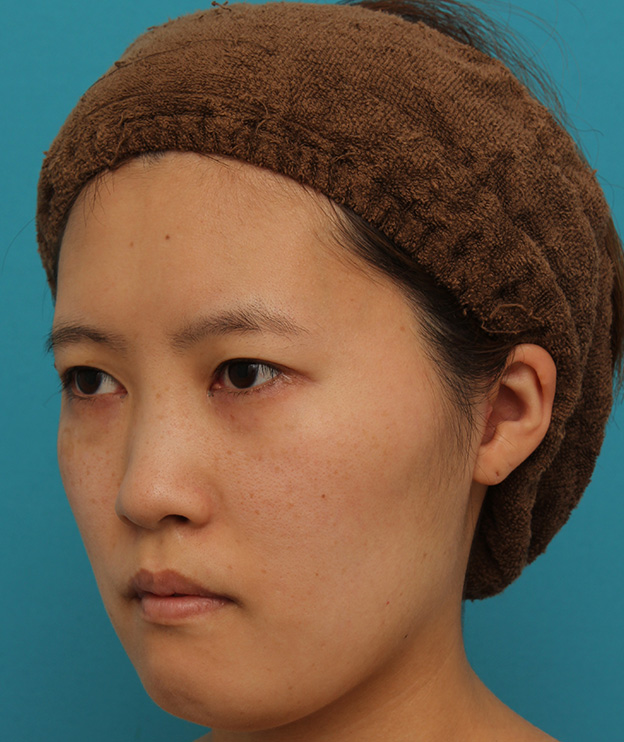 ミニフェイスリフト（頬のたるみ取り）,ミニフェイスリフトの症例 20代女性の頬を中心としたお顔のたるみの改善,1ヶ月後,mainpic_minilift007n.jpg