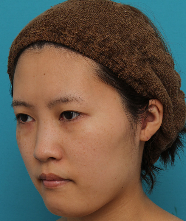 ミニフェイスリフト（頬のたるみ取り）,ミニフェイスリフトの症例 20代女性の頬を中心としたお顔のたるみの改善,3ヶ月後,mainpic_minilift007o.jpg