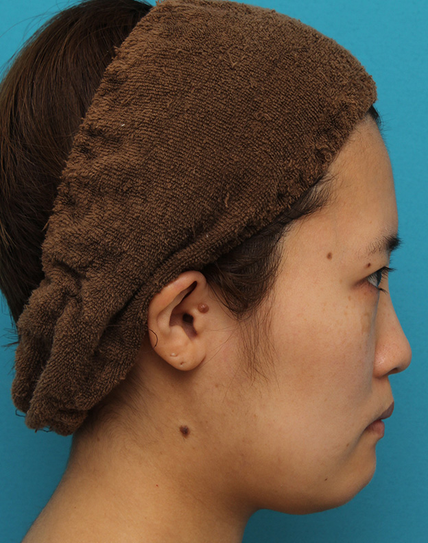 ミニフェイスリフト（頬のたるみ取り）,ミニフェイスリフトの症例 20代女性の頬を中心としたお顔のたるみの改善,手術前,mainpic_minilift007p.jpg