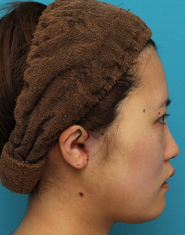 症例写真,ミニフェイスリフトの症例 20代女性の頬を中心としたお顔のたるみの改善,手術直後,mainpic_minilift007q.jpg