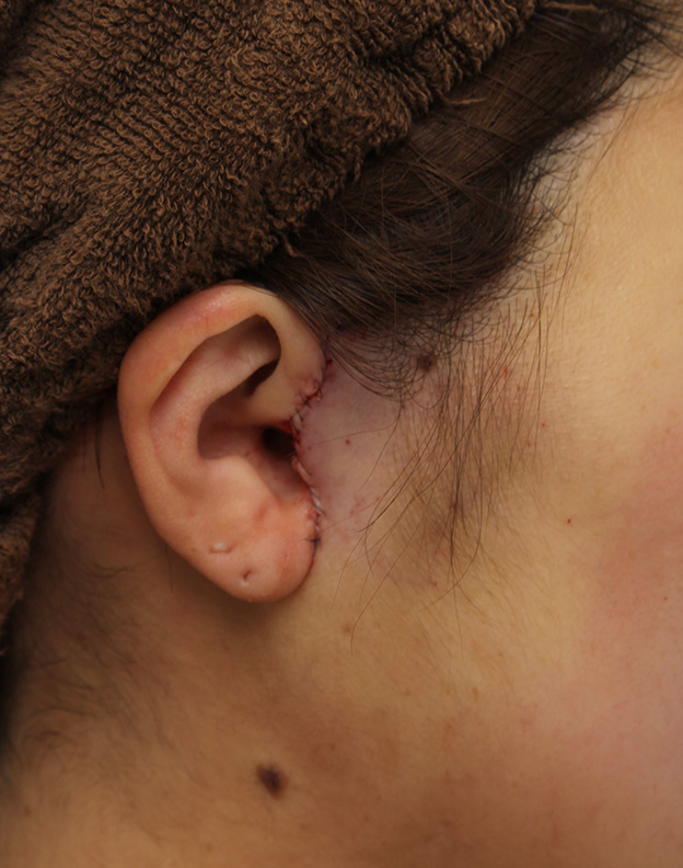 ミニフェイスリフト（頬のたるみ取り）,ミニフェイスリフトの症例 20代女性の頬を中心としたお顔のたるみの改善,手術直後,mainpic_minilift007r.jpg