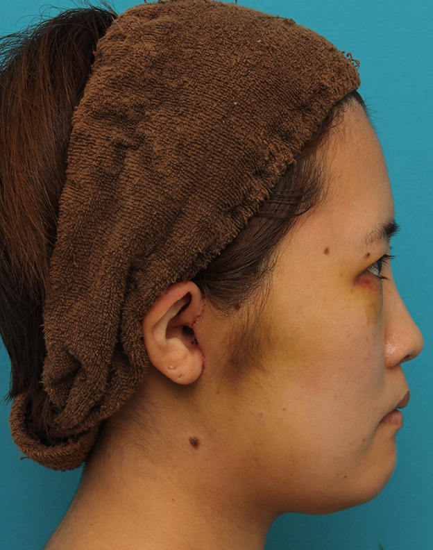 ミニフェイスリフト（頬のたるみ取り）,ミニフェイスリフトの症例 20代女性の頬を中心としたお顔のたるみの改善,1週間後（抜糸時）,mainpic_minilift007s.jpg