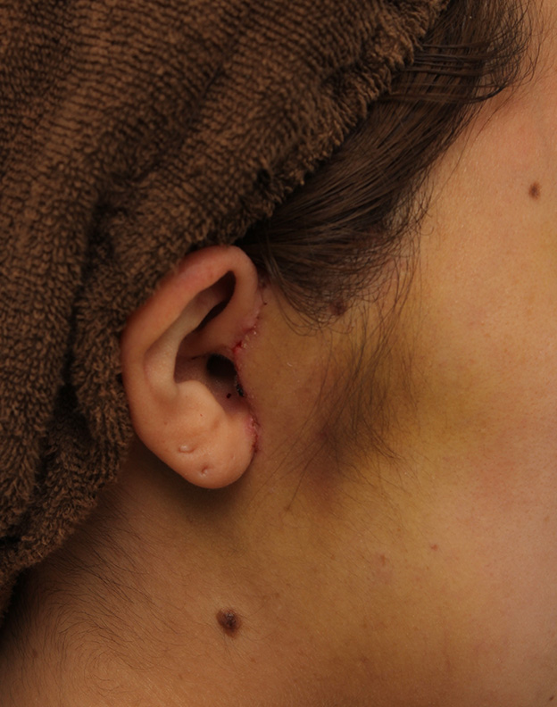 ミニフェイスリフト（頬のたるみ取り）,ミニフェイスリフトの症例 20代女性の頬を中心としたお顔のたるみの改善,1週間後（抜糸時）,mainpic_minilift007t.jpg