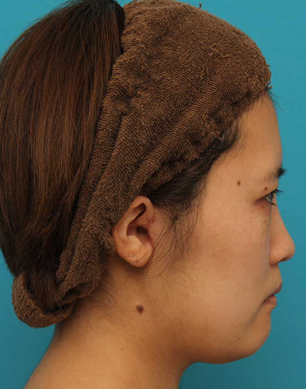 ミニフェイスリフト（頬のたるみ取り）,ミニフェイスリフトの症例 20代女性の頬を中心としたお顔のたるみの改善,1ヶ月後,mainpic_minilift007u.jpg