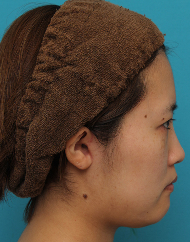 ミニフェイスリフト（頬のたるみ取り）,ミニフェイスリフトの症例 20代女性の頬を中心としたお顔のたるみの改善,3ヶ月後,mainpic_minilift007v.jpg