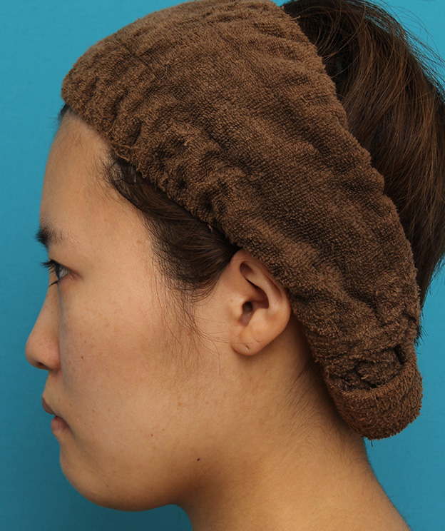 ミニフェイスリフト（頬のたるみ取り）,ミニフェイスリフトの症例 20代女性の頬を中心としたお顔のたるみの改善,手術前,mainpic_minilift007w.jpg