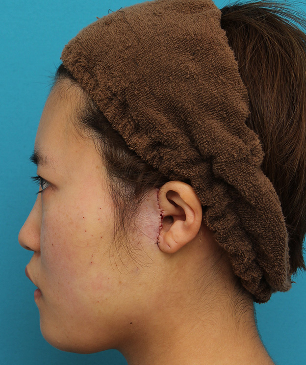ミニフェイスリフト（頬のたるみ取り）,ミニフェイスリフトの症例 20代女性の頬を中心としたお顔のたるみの改善,手術直後,mainpic_minilift007x.jpg