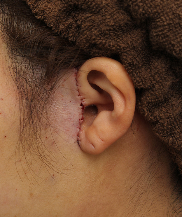 ミニフェイスリフト（頬のたるみ取り）,ミニフェイスリフトの症例 20代女性の頬を中心としたお顔のたるみの改善,手術直後,mainpic_minilift007y.jpg