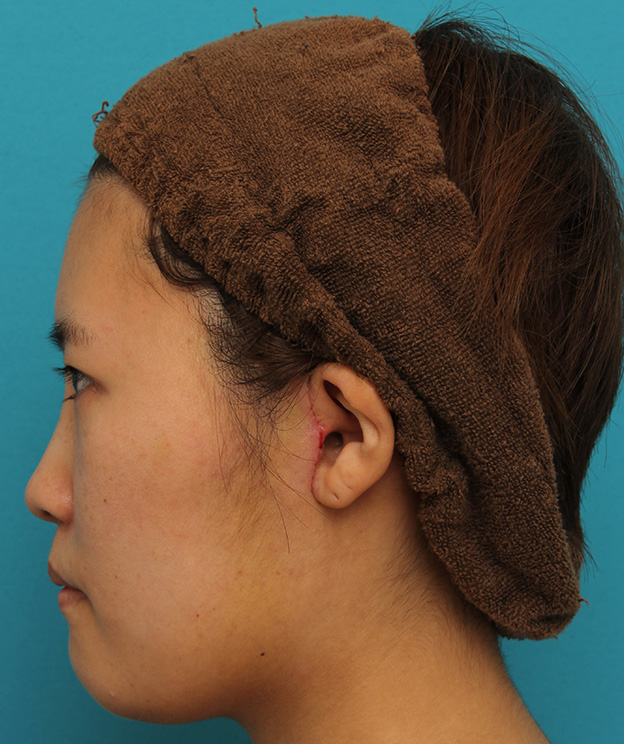 ミニフェイスリフト（頬のたるみ取り）,ミニフェイスリフトの症例 20代女性の頬を中心としたお顔のたるみの改善,1週間後（抜糸時）,mainpic_minilift007z.jpg