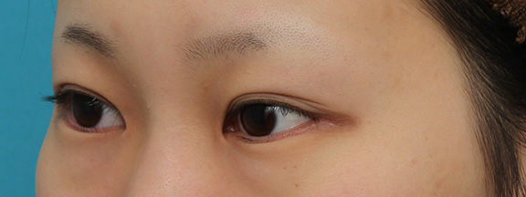 逆さまつ毛修正,目尻切開と下まぶた逆さまつ毛の同時手術の症例写真,After（3ヶ月後）,ba_mejiri020_b03.jpg
