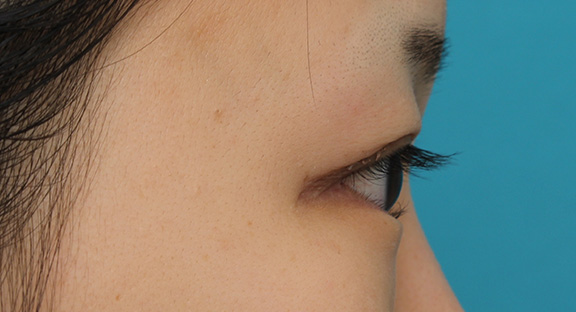 逆さまつ毛修正,目尻切開と下まぶた逆さまつ毛の同時手術の症例写真,After（3ヶ月後）,ba_mejiri020_b04.jpg