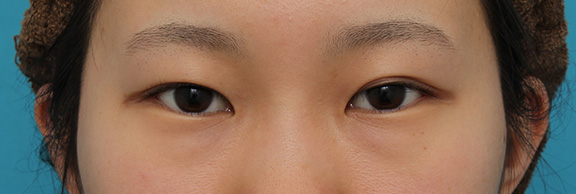 目尻切開,逆さまつ毛修正,目尻切開と下まぶた逆さまつ毛の同時手術の症例写真,Before,ba_mejiri020_b01.jpg