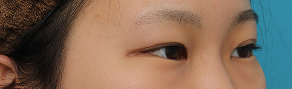 目尻切開,目尻切開と下まぶた逆さまつ毛の同時手術の症例写真,Before,ba_mejiri020_b02.jpg