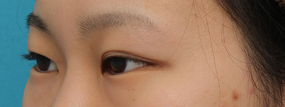 目尻切開,目尻切開と下まぶた逆さまつ毛の同時手術の症例写真,Before,ba_mejiri020_b03.jpg