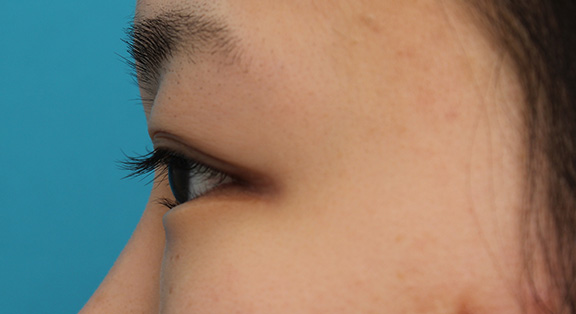 逆さまつ毛修正,目尻切開と下まぶた逆さまつ毛の同時手術の症例写真,Before,ba_mejiri020_b05.jpg