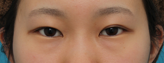 逆さまつ毛修正,目尻切開と下まぶた逆さまつ毛の同時手術の症例写真,手術前,mainpic_mejiri020a.jpg
