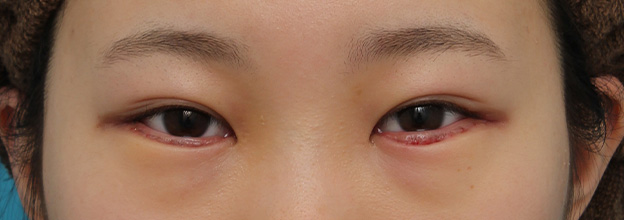 目尻切開,目尻切開と下まぶた逆さまつ毛の同時手術の症例写真,1週間後（抜糸時）,mainpic_mejiri020c.jpg