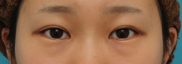 目尻切開,目尻切開と下まぶた逆さまつ毛の同時手術の症例写真,1ヶ月後,mainpic_mejiri020d.jpg
