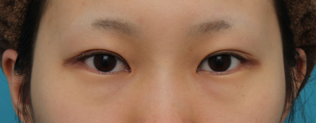 目尻切開,目尻切開と下まぶた逆さまつ毛の同時手術の症例写真,3ヶ月後,mainpic_mejiri020e.jpg