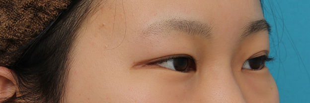 目尻切開,目尻切開と下まぶた逆さまつ毛の同時手術の症例写真,手術前,mainpic_mejiri020f.jpg