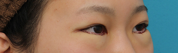 逆さまつ毛修正,目尻切開と下まぶた逆さまつ毛の同時手術の症例写真,手術直後,mainpic_mejiri020g.jpg
