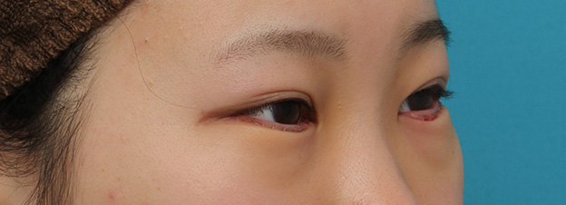 逆さまつ毛修正,目尻切開と下まぶた逆さまつ毛の同時手術の症例写真,1週間後（抜糸時）,mainpic_mejiri020h.jpg