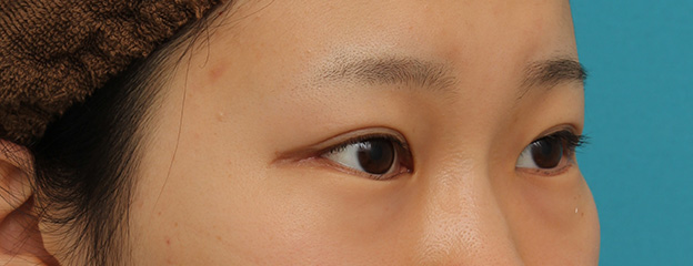 目尻切開,目尻切開と下まぶた逆さまつ毛の同時手術の症例写真,1ヶ月後,mainpic_mejiri020i.jpg