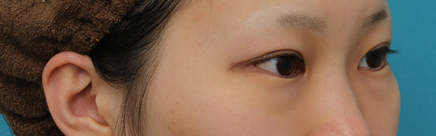 目尻切開,目尻切開と下まぶた逆さまつ毛の同時手術の症例写真,3ヶ月後,mainpic_mejiri020j.jpg