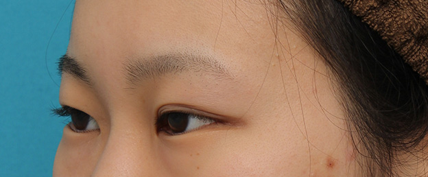 逆さまつ毛修正,目尻切開と下まぶた逆さまつ毛の同時手術の症例写真,手術前,mainpic_mejiri020k.jpg
