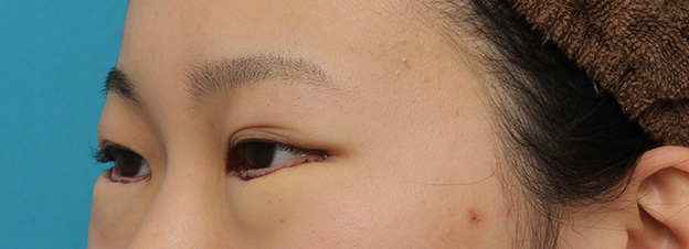 目尻切開,目尻切開と下まぶた逆さまつ毛の同時手術の症例写真,手術直後,mainpic_mejiri020l.jpg