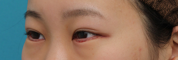 目尻切開,目尻切開と下まぶた逆さまつ毛の同時手術の症例写真,1週間後（抜糸時）,mainpic_mejiri020m.jpg