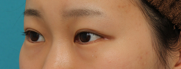 目尻切開,目尻切開と下まぶた逆さまつ毛の同時手術の症例写真,1ヶ月後,mainpic_mejiri020n.jpg