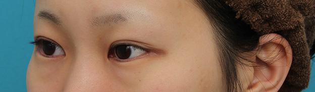 目尻切開,目尻切開と下まぶた逆さまつ毛の同時手術の症例写真,3ヶ月後,mainpic_mejiri020o.jpg