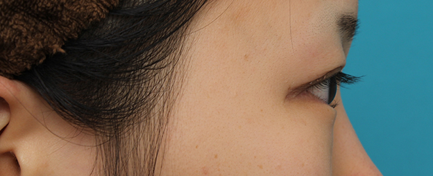 逆さまつ毛修正,目尻切開と下まぶた逆さまつ毛の同時手術の症例写真,3ヶ月後,mainpic_mejiri020t.jpg