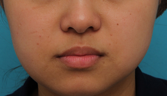 鼻翼縮小（小鼻縮小）,小鼻縮小の症例写真,After（3ヶ月後）,ba_biyoku048_b01.jpg