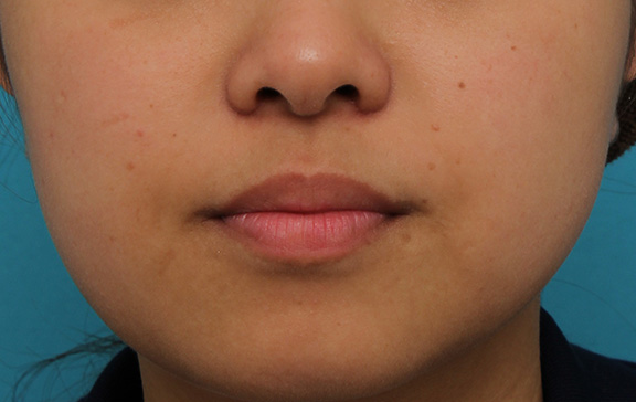 鼻翼縮小（小鼻縮小）,小鼻縮小の症例写真,After（3ヶ月後）,ba_biyoku048_b02.jpg