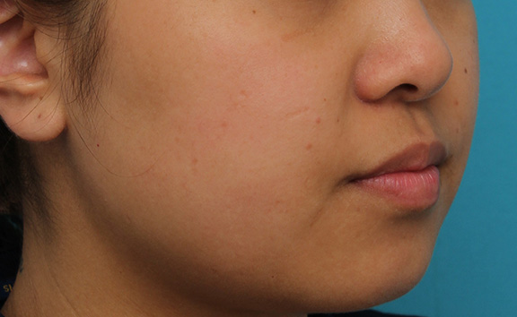 鼻翼縮小（小鼻縮小）,小鼻縮小の症例写真,After（3ヶ月後）,ba_biyoku048_b03.jpg