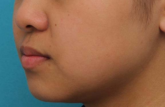 鼻翼縮小（小鼻縮小）,小鼻縮小の症例写真,After（3ヶ月後）,ba_biyoku048_b04.jpg