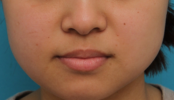 鼻翼縮小（小鼻縮小）,小鼻縮小の症例写真,Before,ba_biyoku048_b01.jpg