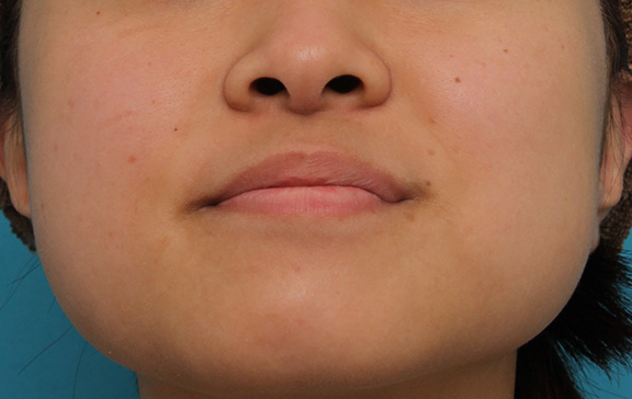 鼻翼縮小（小鼻縮小）,小鼻縮小の症例写真,Before,ba_biyoku048_b02.jpg