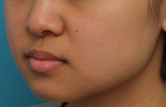 鼻翼縮小（小鼻縮小）,小鼻縮小の症例写真,Before,ba_biyoku048_b04.jpg