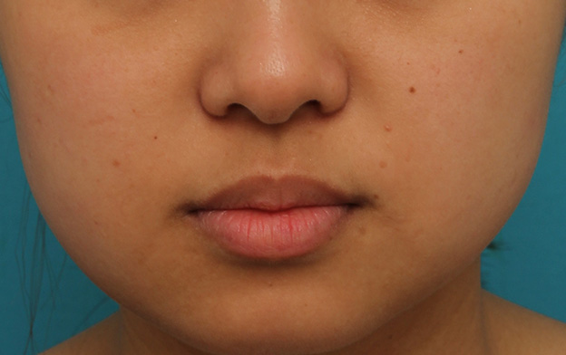 鼻翼縮小（小鼻縮小）,小鼻縮小の症例写真,1ヶ月後,mainpic_biyoku048d.jpg