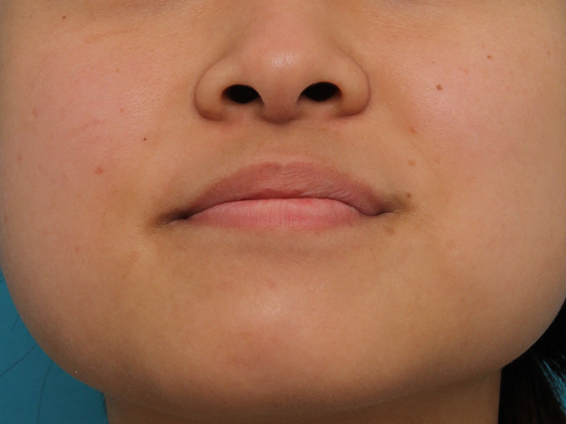 鼻翼縮小（小鼻縮小）,小鼻縮小の症例写真,手術前,mainpic_biyoku048f.jpg