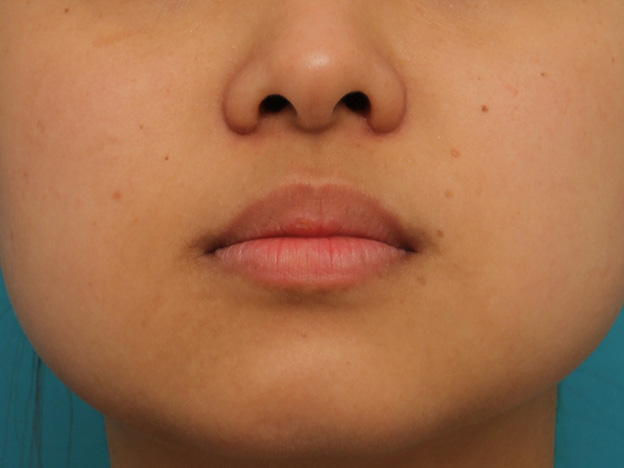 鼻翼縮小（小鼻縮小）,小鼻縮小の症例写真,1ヶ月後,mainpic_biyoku048i.jpg