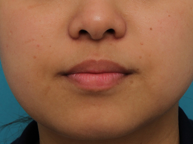 鼻翼縮小（小鼻縮小）,小鼻縮小の症例写真,3ヶ月後,mainpic_biyoku048j.jpg
